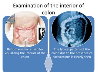 Examination of the interior of
colon
Barium enema is used for
visualizing the interior of the
colon
The typical pattern of the
colon due to the presence of
sacculations is clearly seen
 