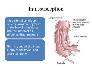 Intussusception
It is a clinical condition in
which a proximal segment
of the bowel invaginates
into the lumen of an
adjoining distal segment
This may cut off the blood
supply to the bowel and
cause gangrene
 