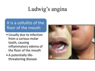 Ludwig’s angina
It is a cellulitis of the
floor of the mouth
• Usually due to infection
from a carious molar
tooth, causing
inflammatory edema of
the floor of the mouth
• A potentially life-
threatening disease
 