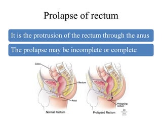 Prolapse of rectum
It is the protrusion of the rectum through the anus
The prolapse may be incomplete or complete
 