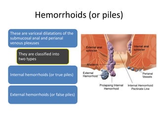 Hemorrhoids (or piles)
These are variceal dilatations of the
submucosal anal and perianal
venous plexuses
They are classified into
two types
Internal hemorrhoids (or true piles)
External hemorrhoids (or false piles)
 