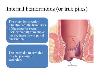 Internal hemorrhoids (or true piles)
These are the saccular
dilatations of the tributaries
of the superior rectal
(hemorrhoidal) vein above
the pectinate line in portal
obstruction
The internal hemorrhoids
may be primary or
secondary
 