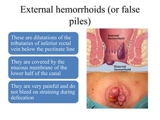 External hemorrhoids (or false
piles)
These are dilatations of the
tributaries of inferior rectal
vein below the pectinate line
They are covered by the
mucous membrane of the
lower half of the canal
They are very painful and do
not bleed on straining during
defecation
 