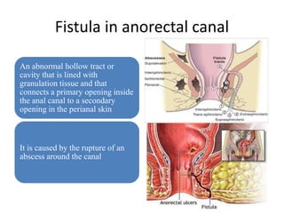 Fistula in anorectal canal
An abnormal hollow tract or
cavity that is lined with
granulation tissue and that
connects a primary opening inside
the anal canal to a secondary
opening in the perianal skin
It is caused by the rupture of an
abscess around the canal
 