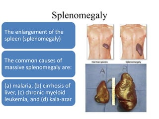 Splenomegaly
The enlargement of the
spleen (splenomegaly)
The common causes of
massive splenomegaly are:
(a) malaria, (b) cirrhosis of
liver, (c) chronic myeloid
leukemia, and (d) kala-azar
 