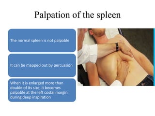 Palpation of the spleen
The normal spleen is not palpable
It can be mapped out by percussion
When it is enlarged more than
double of its size, it becomes
palpable at the left costal margin
during deep inspiration
 