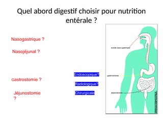 Quel abord digestif choisir pour nutrition
entérale ?
NNasogastrique ?
que ?
Nasojéjunal ?
Nasojéjunal ?
GGastrostomie ?
Jéjunostomie
?
Endoscopique?
Chirurgicale
Radiologique?
 
