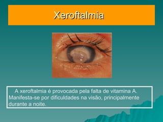 Xeroftalmia  A xeroftalmia é provocada pela falta de vitamina A. Manifesta-se por dificuldades na visão, principalmente durante a noite.  