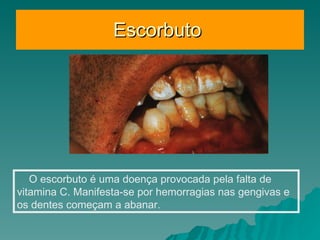Escorbuto  O escorbuto é uma doença provocada pela falta de vitamina C. Manifesta-se por hemorragias nas gengivas e os dentes começam a abanar.  