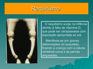 Raquitismo  O raquitismo surge na infância devido à falta de vitamina D, que pode ser ultrapassada com exposição apropriada ao sol.  Manifesta-se por graves deformações do esqueleto, ficando a criança com a coluna vertebral curva e as pernas arqueadas. 