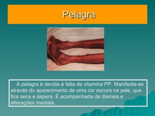 Pelagra A pelagra é devida à falta de vitamina PP. Manifesta-se através do aparecimento de uma cor escura na pele, que fica seca e áspera. É acompanhada de diarreia e alterações mentais.  