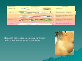 Doenças provocados pela sua carência:  Iodo -  Bócio (aumento da tiróide). 