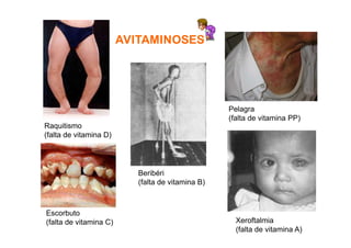 AVITAMINOSES
Raquitismo
(falta de vitamina D)
Beribéri
(falta de vitamina B)
Escorbuto
(falta de vitamina C)
Pelagra
(falta de vitamina PP)
Xeroftalmia
(falta de vitamina A)
 