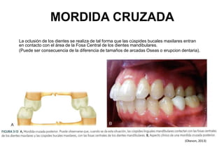 MORDIDA CRUZADA
La oclusión de los dientes se realiza de tal forma que las cúspides bucales maxilares entran
en contacto con el área de la Fosa Central de los dientes mandibulares.
(Puede ser consecuencia de la diferencia de tamaños de arcadas Oseas o erupcion dentaria).
(Okeson, 2013)
 