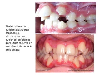 Si el espacio no es
suficiente las fuerzas
musculares
circundantes no
suelen ser suficientes
para situar el diente en
una alineación correcta
en la arcada
http://es.slideshare.net/pecosos/oclusion
 