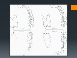 Los dientes anteriores superiores están colocados vestibularmente respecto a sus
contrapartes inferiores.
Esta relación da...