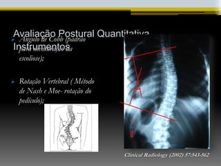 Avaliação Postural Quantitativa
Instrumentos
 Ângulo de Cobb (padrão
para mensuração da
escoliose);
 Rotação Vertebral ( Método
de Nash e Moe- rotação do
pedículo);
Clinical Radiology (2002) 57:543-562
 