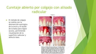 Curetaje abierto por colgajo con alisado
radicular


El método de colgajo
se realiza con la
desinserción quirúrgica
de la encía y el tejido
de la bolsa para lograr
acceso, permitiendo
visualización de la
superficie radicular y
defecto óseo.

 