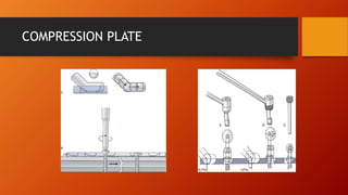 Compression Plate Insulation Aliyu discuss principles of internal fixation | PPTX