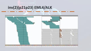 Clinical Integration of NGS for ALK Fusions Identification in NSCLC ...