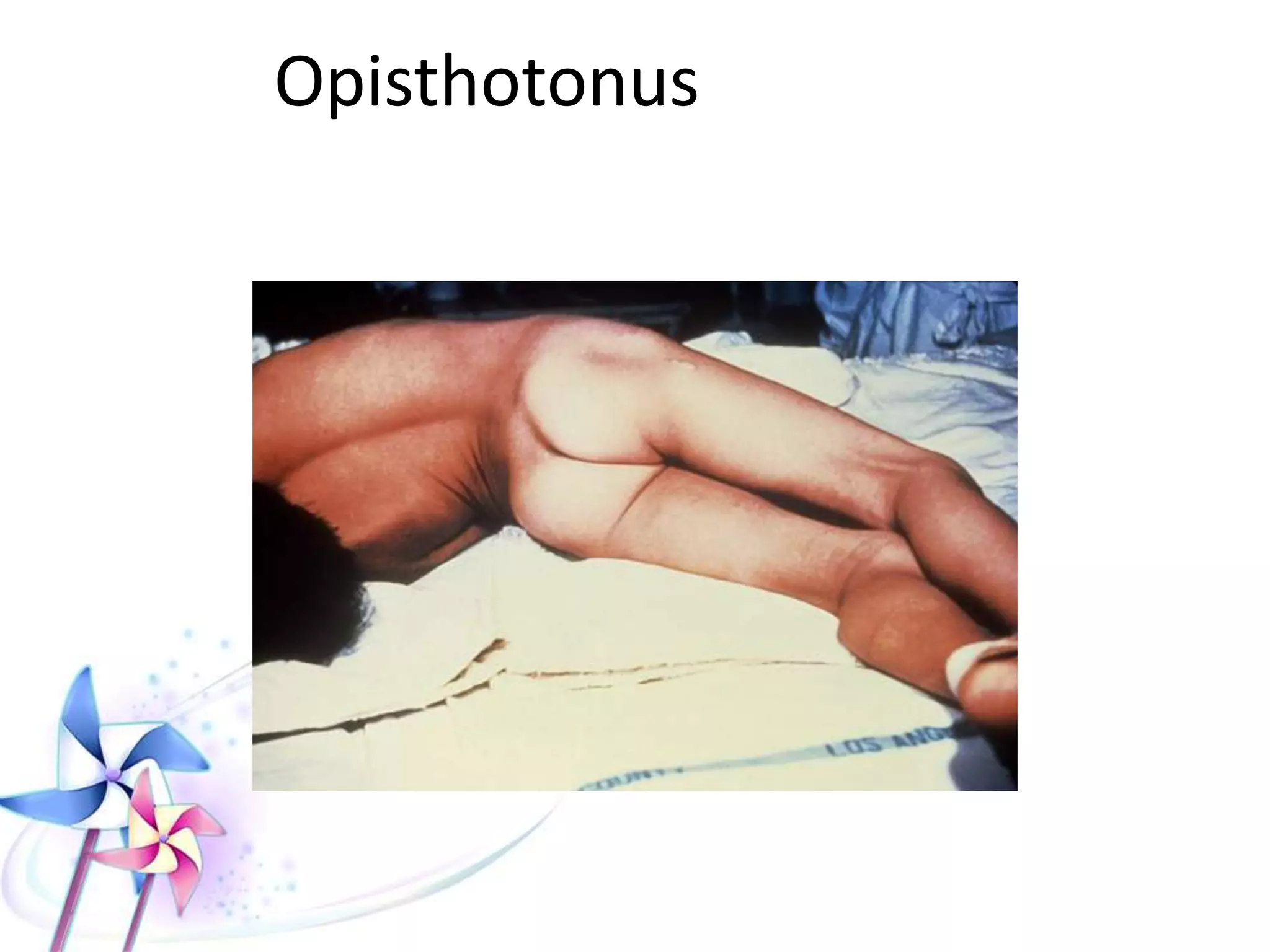 Clinical Manifestations
 TOXIDROME: Symmetrical
generalized fits + Opisthotonus +
Risus sardonicus + Full
consciousness
 Onset of symptoms after 15-30 minutes.
 Starting as restlessness, increased visual &
auditory acuity, nausea, vomiting, and
muscle twitching, then sudden onset of
generalized, extremely painful tonic fits
while patient is fully conscious.
 