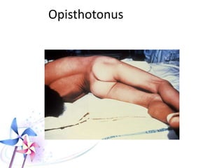 Clinical Manifestations
 TOXIDROME: Symmetrical
generalized fits + Opisthotonus +
Risus sardonicus + Full
consciousness
 Onset of symptoms after 15-30 minutes.
 Starting as restlessness, increased visual &
auditory acuity, nausea, vomiting, and
muscle twitching, then sudden onset of
generalized, extremely painful tonic fits
while patient is fully conscious.
 