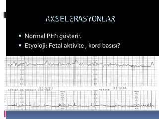 AKSELERASYONLAR
 Normal PH’ı gösterir.
 Etyoloji: Fetal aktivite , kord basısı?
Normal Antenatal KTG
 