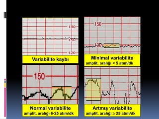 Variabilite‫‏‬kaybı Minimal variabilite
amplit. aralığı‫<‏‬ 5 atım/dk
Normal variabilite
amplit. aralığı‫‏52-6‏‬atım/dk
Artmış‫‏‬variabilite
amplit. aralığı‫‏‬ 25‫‏‬atım/dk
 
