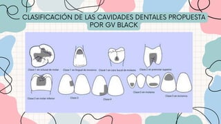 CLASIFICACIÓN DE LAS CAVIDADES DENTALES PROPUESTA
POR GV BLACK
 