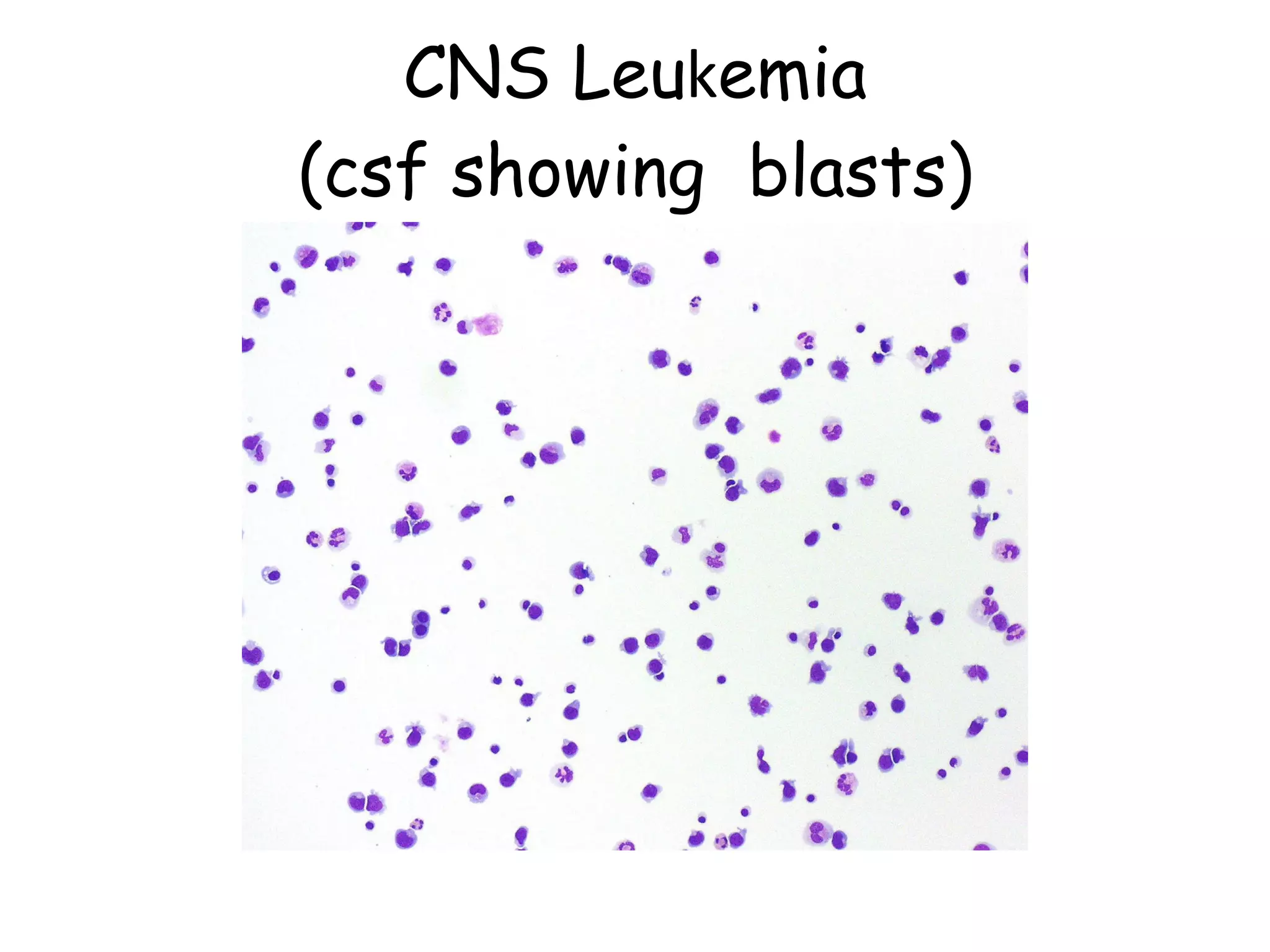 Acute Lymphoblastic Leukaemia | PPT