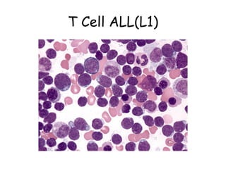 T Cell ALL(L1) 