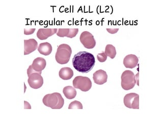 T Cell ALL (L2) Irregular clefts of nucleus 