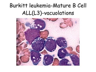 Burkitt leukemia-Mature B Cell ALL(L3)-vacuolations 