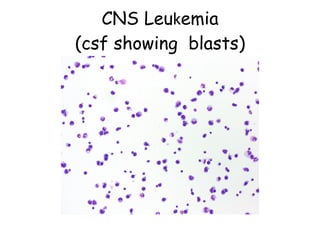 CNS Leu k emia (csf showing  blasts) 