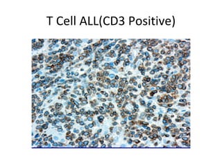 T Cell ALL(CD3 Positive) 