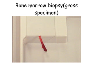 Bone marrow biopsy(gross specimen) 
