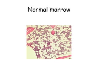Normal marrow 
