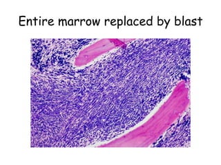 Entire marrow replaced by blast 