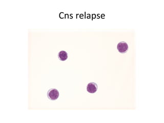 Cns relapse 