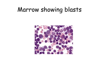 Marrow showing blasts 