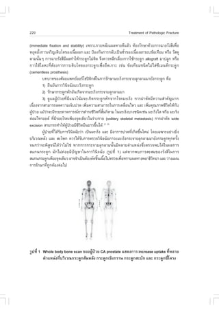 220                                                            Treatment of Pathologic .racture

(immediate fixation and stability) à¾ÃÒÐÀÒÂËÅÑ§á¼ÅËÒÂ´ÕáÅŒÇ µŒÍ§ÃÑ¡ÉÒ´ŒÇÂ¡ÒÃ©ÒÂÃÑ§ÊÕà¾×Í   è
ËÂØ´ÂÑ§¡ÒÃà¨ÃÔ­àµÔºâµ¢Í§à¹×Í§Í¡ áÅÐ »‡Í§¡Ñ¹¡ÒÃ¡ÅÑºà»š¹«éÒ¢Í§à¹×Í§Í¡ÃÍº¢ŒÍà·ÕÂÁ ËÃ×Í ÇÑÊ´Ø
        é                         é                          í     é
´ÒÁ¹Ñ¹æ ¡ÒÃ©ÒÂÃÑ§ÊÕÁ¼Å·íÒãËŒ¡ÃÐ´Ù¡äÁ‹µ´ ¨Ö§¤ÇÃËÅÕ¡àÅÕÂ§¡ÒÃãªŒ¡ÃÐ´Ù¡ allograft ÁÒ»ÅÙ¡ ËÃ×Í
      é                  Õ                   Ô           è
¡ÒÃãªŒâÅËÐ·ÕèµŒÍ§¡ÒÃ¡ÒÃàµÔºâµ¢Í§¡ÃÐ´Ù¡à¾×èÍÂÖ´à¡ÒÐ àª‹¹ ¢ŒÍà·ÕÂÁª¹Ô´äÁ‹äÊ‹«ÕàÁ¹µ¡ÃÐ´Ù¡
(cementless prosthesis)
          º·ºÒ·¢Í§ÈÑÅÂá¾·ÂÍÍÃâ¸»´¡Êã¹¡ÒÃÃÑ¡ÉÒÁÐàÃç§¡ÃÐ¨ÒÂÅØ¡ÅÒÁÁÒÂÑ§¡ÃÐ´Ù¡ ¤×Í
                                           Ô
          1) Â×¹ÂÑ¹¡ÒÃÇÔ¹¨©ÑÂÁÐàÃç§¡ÃÐ´Ù¡
                             Ô
          2) ÃÑ¡ÉÒ¡ÃÐ´Ù¡ËÑ¡ÍÑ¹à¡Ô´¨Ò¡ÁÐàÃç§¡ÃÐ¨ÒÂÅØ¡ÅÒÁÁÒ
          3) ´ÙáÅ¼ÙŒ»†ÇÂ·ÕèÁÕá¹Çâ¹ŒÁ¨Ðà¡Ô´¡ÃÐ´Ù¡ËÑ¡¨Ò¡âÃ¤ÁÐàÃç§ ¡ÒÃ¼‹ÒµÑ´ÁÕ¤ÇÒÁÊíÒ¤Ñ­ÁÒ¡
à¹×Í§¨Ò¡ÊÒÁÒÃ¶Å´¤ÇÒÁà¨çº»Ç´ à¾ÔÁ¤ÇÒÁÊÒÁÒÃ¶ã¹¡ÒÃà¤Å×Í¹äËÇ áÅÐ à¾ÔÁ¤Ø³ÀÒ¾ªÕÇµãËŒ¡º
    è                                    è                     è         è         Ô     Ñ
¼Ù»ÇÂ áÁŒÇÒ¨ÐÁÕÃÐÂÐ¤Ò´¡ÒÃ³¡ÒÃ´íÒÃ§ªÕÇµ·ÕÊ¹¡çµÒÁ ã¹ÁÐàÃç§ºÒ§ª¹Ô´àª‹¹ ÁÐàÃç§äµ ËÃ×Í ÁÐàÃç§
  Œ †         ‹                                Ô è Ñé
µ‹ÍÁä·ÃÍÂ´ ·ÕÁÃÍÂâÃ¤à¾ÕÂ§¨Ø´à´ÕÂÇã¹Ã‹Ò§¡ÒÂ (solitary skeletal metastasis) ¡ÒÃ¼‹ÒµÑ´ wide
                    è Õ
excision ÊÒÁÒÃ¶·íÒãËŒ¼»ÇÂÁÕªÇµÂ×¹ÂÒÇ¢Ö¹ä´Œ (1, 2)
                           ÙŒ †     ÕÔ          é
          ¼Ù»ÇÂ·Õä´ŒÃº¡ÒÃÇÔ¹¨©ÑÂÇ‹Ò à»š¹ÁÐàÃç§ áÅÐ ÁÕÍÒ¡ÒÃ»Ç´·Õà¡Ô´¢Ö¹ãËÁ‹ â´Âà©¾ÒÐÍÂ‹Ò§ÂÔ§
            Œ † è Ñ             Ô                                è é                           è
ºÃÔàÇ³ËÅÑ§ áÅÐ ÊÐâ¾¡ ¤ÇÃä´ŒÃº¡ÒÃµÃÇ¨ÇÔ¹¨©ÑÂÀÒÇÐÁÐàÃç§¡ÃÐ¨ÒÂÅØ¡ÅÒÁÁÒÂÑ§¡ÃÐ´Ù¡·Ø¡¤ÃÑ§
                                       Ñ            Ô                                        é
¨¹¡Ç‹Ò¨Ð¾ÔÊÙ¨¹ä´ŒÇ‹ÒäÁ‹ãª‹ ËÒ¡¡ÒÃ¡ÃÐ¨ÒÂÅØ¡ÅÒÁ¹Ñé¹ÁÕËÅÒÂµíÒáË¹‹§«Öè§µÃÇ¨¾ºä´Œã¹¼Å¡ÒÃ
Êá¡¹¡ÃÐ´Ù¡ ÁÑ¡äÁ‹¤‹ÍÂÁÕ»˜­ËÒã¹¡ÒÃÇÔ¹Ô¨©ÑÂ (ÃÙ»·Õè 1) áµ‹ËÒ¡¾º¡ÒÃÊÐÊÁ¢Í§ÃÑ§ÊÕã¹¡ÒÃ
Êá¡¹¡ÃÐ´Ù¡à¾ÕÂ§¨Ø´à´ÕÂÇ ÍÒ¨¨íÒà»š¹µŒÍ§µÑ´ªÔ¹à¹×Íä»µÃÇ¨à¾×Í·ÃÒº¼Å·Ò§¾ÂÒ¸ÔÇ·ÂÒ áÅÐ ÇÒ§á¼¹
                                                  é é      è                Ô
¡ÒÃÃÑ¡ÉÒ·Õ¶¡µŒÍ§µ‹Íä»
                è Ù




ÃÙ»·Õè 1 Whole body bone scan ¢Í§¼ÙŒ»†ÇÂ CA prostate áÊ´§¡ÒÃ increase uptake ·ÕèËÅÒÂ
         µíÒáË¹‹§·ÕèºÃÔàÇ³¡ÃÐ´Ù¡ÊÑ¹ËÅÑ§ ¡ÃÐ´Ù¡àªÔ§¡ÃÒ¹ ¡ÃÐ´Ù¡ÊÐºÑ¡ áÅÐ ¡ÃÐ´Ù¡«Õèâ¤Ã§
 
