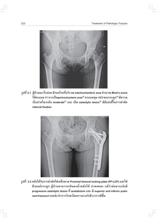 222                                                        Treatment of Pathologic .racture




ÃÙ»·Õè 2.1 ¼ÙŒ»†ÇÂÁÐàÃç§»Í´ ÁÕÃÍÂâÃ¤·ÕèºÃÔàÇ³ intertrochanteric area ¤íÒ¹Ç³ Mirel’s score
           ä´Œ¤Ðá¹¹ 11 ¨Ò¡à»š¹pertrochanteric area(3) ¤ÃÍº¤ÅØÁ >2/3 ¢Í§¡ÃÐ´Ù¡(3) ÁÕ¤ÇÒÁ
           à¨çº»Ç´ã¹ÃÐ´Ñº moderate(2) áÅÐ à»š¹ osteolytic lesion(3) ÁÕ¢ŒÍº‹§ªÕéã¹¡ÒÃ¼‹ÒµÑ´
           internal fixation




ÃÙ»·Õè 2.2 ËÅÑ§ä´ŒÃº¡ÒÃ¼‹ÒµÑ´ãÊ‹àËÅç¡´ÒÁ Proximal femoral locking plate (P.-LCP) áÅÐãÊ‹
                   Ñ
           «ÕàÁ¹µ¡ÃÐ´Ù¡ ¼ÙŒ»†ÇÂÊÒÁÒÃ¶à´Ô¹Å§¹éíÒË¹Ñ¡ä´Œ »Ç´Å´Å§ áÁŒÇ‹Òµ‹ÍÁÒ¨ÐÂÑ§ÁÕ
           progressive osteolytic lesion ·Õè acetabulum áÅÐ ÁÕ superior and inferior pubic
           rami fractureÀÒÂËÅÑ§ ·íÒ¡ÒÃÃÑ¡ÉÒâ´Â¡ÒÃ©ÒÂÃÑ§ÊÕ ÍÒ¡ÒÃ´Õ¢Öé¹
 