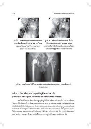 224                                                         Treatment of Pathologic .racture




 ÃÙ»·Õè 4.1 ÀÒ¾ Pre-operative embolization ÃÙ»·Õè 4.2 ËÅÑ§¡Ò·íÒ embolization ·ÕèàÊŒ¹
 áÊ´§àÊŒ¹àÅ×Í´ÁÒàÅÕéÂ§¨íÒ¹Ç¹ÁÒ¡ºÃÔàÇ³       àÅ×Í´ medial circuflex femoral artery
     neck of femur ã¹¼ÙŒ»†ÇÂ renal cell   áÊ´§ãËŒàËç¹Ç‹ÒÁÕàÅ×Í´ÁÒàÅÕéÂ§¹ŒÍÂÅ§à¾×èÍÅ´
            carcinoma metastasis            »ÃÔÁÒ³¡ÒÃÊÙ­àÊÕÂàÅ×Í´ÃÐËÇ‹Ò§¼‹ÒµÑ´




      ÃÙ»·Õè 4.3 ÀÒ¾¶‹ÒÂ·Ò§ÃÑ§ÊÕÇÔ·ÂÒ¢Í§ Long stem hemiarthroplasty ÀÒÂËÅÑ§¡ÒÃ·íÒ
                                       Embolization

ËÅÑ¡¡ÒÃÃÑ¡ÉÒà¹×éÍ§Í¡¡ÃÐ´Ù¡·ØµÔÂÀÙÁÔâ´Â¡ÒÃ¼‹ÒµÑ´
(Principles of Surgical Treatment for Skeletal Metastases)
        à·¤â¹âÅÂÕã¹¡ÒÃ¼èÒµÑ´ÁÐàÃç§¡ÃÐ´Ù¡·ØµÂÀÙÁä´éÃº¡ÒÃ¾Ñ²¹ÒÍÂèÒ§µèÍà¹×Í§ àªè¹ ¡ÒÃ¾Ñ²¹Ò-
                                           Ô Ô Ñ                         è
ÇÑÊ´ØàÁ··ÑÅÅÔ¡ÍÑÅÅÍÂ´ ¡ÒÃ¾Ñ²¹ÒÃÙ»áºº¢Í§á¡¹´ÒÁ¡ÃÐ´Ù¡ (third-generation interlocked IM rods)
áÅÐ¢ŒÍà·ÕÂÁª¹Ô´¾ÔàÈÉ (prosthesis design áÅÐ modular segmental replacement endoprosthesis)
¡ÒÃàÊÃÔÁ«ÕàÁ¹µ¡ÃÐ´Ù¡à¾×ÍãËŒä´Œ¤ÇÒÁá¢ç§áÃ§·Ñ¹·Õã¹¡ÒÃãÊ‹àËÅç¡´ÒÁ¡ÃÐ´Ù¡ ·Ñ§¹Õ¼»ÇÂ¨íÒà»š¹µŒÍ§
                         è                                                 é é ÙŒ †
ä´ŒÃº adjuvant therapy àª‹¹ à¤ÁÕºÒºÑ´ áÅÐ ÃÑ§ÊÕÃ¡ÉÒÃ‹ÇÁ¡Ñº¡ÒÃ¼‹ÒµÑ´ ¨Ö§¨íÒà»š¹µŒÍ§ÁÕ·Áá¾·Â
    Ñ                             í             Ñ                                    Õ
ÊËÊÒ¢Òª‹ÇÂÇÒ§á¼¹¡ÒÃÃÑ¡ÉÒÃ‹ÇÁ¡Ñ¹à¾×Í¤§ÊÀÒ¾¡ÃÐ´Ù¡ãËŒá¢ç§áÃ§ÀÒÂËÅÑ§¡ÒÃ¼‹ÒµÑ´
                                      è
 