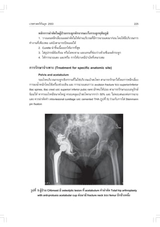 àÇªÈÒÊµÃ·¹ÂØ¤ 2553
          Ñ                                                                               225

       ËÅÑ¡¡ÒÃ¼‹ÒµÑ´ã¹¼ÙŒ»†ÇÂ¡ÃÐ´Ù¡ËÑ¡¨Ò¡ÁÐàÃç§¡ÃÐ´Ù¡·ØµÔÂÀÙÁÔ
       1. ÇÒ§á¼¹ËÅÕ¡àÅÕÂ§á¼Å¼‹ÒµÑ´äÁ‹ãËŒ¼Ò¹ºÃÔàÇ³·ÕÁ¡ÒÃ©ÒÂáÊ§ÁÒ¡‹Í¹ â´ÂãËŒÁºÃÔàÇ³¡ÒÃ
                           è              ‹        è Õ                     Õ
·íÒ§Ò¹·Õà¾ÕÂ§¾Í áµ‹Â§ÊÒÁÒÃ¶»´á¼Åä´Œ
        è            Ñ
       2. Curette ¹íÒªÔ¹à¹×ÍÍÍ¡ãËŒÁÒ¡·ÕÊ´
                         é é           èØ
       3. ãÊ‹Í»¡Ã³¢Íà·ÕÂÁ ËÃ×ÍâÅËÐ´ÒÁ áÅÐá·¹·ÕªÍ§Ç‹Ò§´ŒÇÂ«ÕàÁ¹µ¡ÃÐ´Ù¡
              Ø        Œ                         è ‹
       4. ãËŒ¡ÒÃ©ÒÂáÊ§ áÅÐ/ËÃ×Í ¡ÒÃãËŒÂÒà¤ÁÕºÒºÑ´·ÕàËÁÒÐÊÁ
                                               í     è

¡ÒÃÃÑ¡ÉÒ¨íÒà¾ÒÐ (Treatment for specific anatomic site)
       Pelvis and acetabulum
           ÃÍÂâÃ¤ºÃÔàÇ³¡ÃÐ´Ù¡àªÔ§¡ÃÒ¹·ÕäÁ‹ãª‹ºÃÔàÇ³àºŒÒÊÐâ¾¡ ÊÒÁÒÃ¶ÃÑ¡ÉÒä´Œâ´Â¡ÒÃËÅÕ¡àÅÕÂ§
                                           è                                                 è
¡ÒÃÅ§¹éÒË¹Ñ¡â´ÂãªŒà¤Ã×Í§ª‹ÇÂà´Ô¹ áÅÐ ¡ÒÃ©ÒÂáÊ§ÀÒÇÐ avulsion fracture ¢Í§ superior/inferior
         í                è
iliac spines, iliac crest áÅÐ superior/ inferior pubic rami ÁÑ¡¾ºä´ŒºÍÂ ÊÒÁÒÃ¶ÃÑ¡ÉÒáººÍ¹ØÃ¡É
                                                                     ‹                     Ñ
¹ÔÂÁä´Œ ËÒ¡ÃÍÂâÃ¤ÁÕ¢¹Ò´ãË­‹ ¤ÃÍº¤ÅØÁàºŒÒÊÐâ¾¡ÁÒ¡¡Ç‹Ò 50% áÅÐ äÁ‹µÍºÊ¹Í§µ‹Í¡ÒÃ©ÒÂ
áÊ§ ¤ÇÃ¼‹ÒµÑ´·íÒ intra-lesional curettage áÅÐ cemented THA (ÃÙ»·Õè 5) Ã‹ÇÁ¡Ñº¡ÒÃãÊ‹ Steinmann
pin fixation




 ÃÙ»·Õè 5 ¼Ù»ÇÂ CAbreast ÁÕ osteolytic lesion ·Õè acetabulum ·íÒ¼‹ÒµÑ´ Total hip arthroplasty
            Œ †
        with anti-protusio acetabular cup µ‹ÍÁÒÁÕ fracture neck ¢Í§ femur ÍÕ¡¢ŒÒ§Ë¹Ö§  è
 