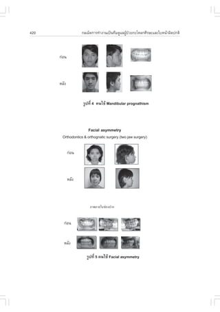 420                 ¡ÅàÁç´¡ÒÃ·íÒ§Ò¹à»š¹·ÕÁ´ÙáÅ¼Ù»ÇÂ¡ÐâËÅ¡ÈÕÃÉÐáÅÐãºË¹ŒÒ¼Ô´»¡µÔ
                                                Œ †



      ¡‹Í¹



      ËÅÑ§


                    ÃÙ»·Õè 4 ¤¹ä¢Œ Mandibular prognathism



                       .acial asymmetry
       Orthodontics & orthognatic surgery (two jaw surgery)

             ¡‹Í¹



             ËÅÑ§




        ¡‹Í¹


        ËÅÑ§

                      ÃÙ»·Õè 5 ¤¹ä¢Œ .acial asymmetry
 