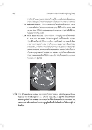 462                                                    ÀÒ¾ÃÑ§ÊÕÇÔ¹Ô¨©ÑÂÃÐºº»ÃÐÊÒ·ã¹¼ÙŒ»†ÇÂÍØºÑµÔàËµØ

                   ¡ÒÃ·íÒ CT scan ¨ÐÊÒÁÒÃ¶ºÍ¡ºÃÔàÇ³·ÕÁ¡ÒÃ¡´àºÕÂ´¢Í§à¹×ÍÊÁÍ§áÅÐ
                                                                  è Õ                         é
                   ÊÒÁÒÃ¶ãËŒ¢ÍÁÙÅà¡ÕÂÇ¡Ñº¡ÒÃàÅ×Í´ÍÍ¡ã¹à¹×ÍÊÁÍ§¡‹Í¹¡ÒÃÃÑ¡ÉÒä´ŒÍ¡´ŒÇÂ
                                   Œ   è                           é                                Õ
             1.1.3 Diastatic fracture à»š¹¡ÒÃáµ¡¢Í§¡ÃÐâËÅ¡ÈÕÃÉÐ·Õèáµ¡¼‹Ò¹ suture
                   ¡ÒÃáµ¡ª¹Ô´·íÒãËŒ suture áÂ¡ÍÍ¡áÅÐÍÒ¨·íÒãËŒÁÕ¡ÒÃ©Õ¡¢Ò´¢Í§ dural
                   venous sinus ·íÒãËŒà¡Ô´ venous epidural hematoma ¡ÒÃáµ¡ª¹Ô´¹ÕÁ¡¾º               é Ñ
                   ã¹¼Ù»ÇÂ·ÒÃ¡ËÃ×Íà´ç¡àÅç¡
                       Œ †
             1.1.4 Skull base fracture à»š ¹ ¡ÒÃáµ¡¢Í§¡ÃÐ´Ù ¡ °Ò¹¡ÃÐâËÅ¡ÈÕ Ã ÉÐ
                   CT scan áºº thin slices à¹×Í§¨Ò¡¡ÒÃ´Ù¡ºÃÔàÇ³¹ÕÁ¢¹Ò´àÅç¡ ¡ÒÃáµ¡
                                                       è                         é Õ
                   ª¹Ô ´ ¹Õé ÁÑ ¡ ¾ºã¹¡Ã³Õ ·Õè ÁÕ ¡ ÒÃºÒ´à¨ç º ¨Ò¡ÍØ ºÑ µÔ à ËµØ ·Õè ÃØ ¹ áÃ§áÅÐÁÑ ¡ ÁÕ ¼ Å
                   µÒÁÁÒ¢Í§¡ÒÃºÒ´à¨çºàª‹¹ ¡ÒÃ·íÒ§Ò¹¢Í§ÃÐºº»ÃÐÊÒ·¼Ô´»¡µÔàª‹¹
                   ¡ÒÃÁÍ§àËç¹, ¡ÒÃä´ŒÂ¹ ËÃ×ÍÍÒ¨¾º¡Ñº¡ÒÃºÒ´à¨çº¢Í§ËÅÍ´àÅ×Í´ä´Œàª‹¹
                                           Ô
                   arterial dissection, aneurysm ËÃ×Í arteriovenous fistula à»š¹µŒ¹ à¹×Í§¨Ò¡     è
                   ºÃÔàÇ³¡ÃÐ´Ù¡°Ò¹ÊÁÍ§ÁÕ foramen áÅÐ fissure µ‹Ò§æ ·Õà»š¹·Ò§à´Ô¹¢Í§àÊŒ¹
                                                                                     è
                   »ÃÐÊÒ·áÅÐËÅÍ´àÅ×Í´·Õèä»àÅÕéÂ§ÊÁÍ§·ÕèÊíÒ¤Ñ­·Ñé§ËÅÍ´àÅ×Í´á´§áÅÐ
                   ËÅÍ´àÅ×Í´´íÒ (ÃÙ»·Õè 2)




                                                               Þ



ÃÙ»·Õè 2 ÀÒ¾ CT scan bone window ¢Í§¡ÃÐ´Ù¡ºÃÔàÇ³°Ò¹ÊÁÍ§ áÊ´§ horizontal linear
         fracture ¢Í§ left temporal bone ºÃÔàÇ³ mastoid part (ÅÙ¡ÈÃ) â´ÂÁÕ¡ÒÃáµ¡
         ¢Í§¡ÃÐ´Ù¡¼‹Ò¹ä»ÂÑ§ middle ear cavity «Öè§·íÒãËŒÁÕàÅ×Í´ÍÍ¡ã¹ºÃÔàÇ³ middle ear
         cavity áÅÐÍÒ¨ÁÕ¡ÒÃà¤Å×Í¹µÑÇ¢Í§¡ÃÐ´Ù¡ËÙÃÇÁ´ŒÇÂ«Ö§ÁÑ¡ÁÕ¼Å¡Ñº¡ÒÃä´ŒÂ¹¢Í§¼Ù»ÇÂ
                               è                 ‹         è               Ô     Œ †
         Ã‹ÇÁ´ŒÇÂ
 