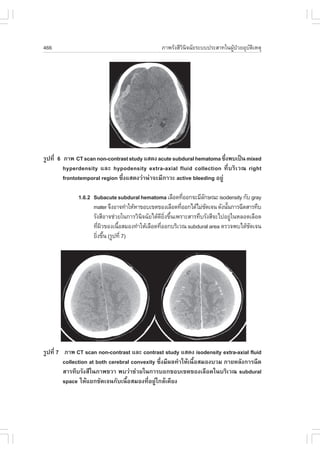 466                                            ÀÒ¾ÃÑ§ÊÕÇÔ¹Ô¨©ÑÂÃÐºº»ÃÐÊÒ·ã¹¼ÙŒ»†ÇÂÍØºÑµÔàËµØ




ÃÙ»·Õè 6 ÀÒ¾ CT scan non-contrast study áÊ´§ acute subdural hematoma «Ö§¾ºà»š¹ mixed
                                                                           è
         hyperdensity áÅÐ hypodensity extra-axial fluid collection ·ÕèºÃÔàÇ³ right
         frontotemporal region «Öè§áÊ´§Ç‹Ò¹‹Ò¨ÐÁÕÀÒÇÐ active bleeding ÍÂÙ‹

             1.6.2 Subacute subdural hematoma àÅ×Í´·ÕÍÍ¡¨ÐÁÕÅ¡É³Ð isodensity ¡Ñº gray
                                                         è       Ñ
                   mater ¨Ö§ÍÒ¨·íÒãËŒËÒ¢Íºà¢µ¢Í§àÅ×Í´·ÕÍÍ¡ä´ŒäÁ‹ª´à¨¹ ´Ñ§¹Ñ¹¡ÒÃ©Õ´ÊÒÃ·Öº
                                                       è           Ñ       é
                   ÃÑ§ÊÕÍÒ¨ª‹ÇÂã¹¡ÒÃÇÔ¹¨©ÑÂä´Œ´Â§¢Ö¹à¾ÃÒÐÊÒÃ·ÖºÃÑ§ÊÕ¨Ðä»ÍÂÙã¹ËÅÍ´àÅ×Í´
                                        Ô      Õ Ôè é                        ‹
                   ·Õ¼Ç¢Í§à¹×ÍÊÁÍ§·íÒãËŒàÅ×Í´·ÕÍÍ¡ºÃÔàÇ³ subdural area µÃÇ¨¾ºä´Œª´à¨¹
                      è Ô      é                è                                  Ñ
                   ÂÔ§¢Ö¹ (ÃÙ»·Õè 7)
                     è é




ÃÙ»·Õè 7 ÀÒ¾ CT scan non-contrast áÅÐ contrast study áÊ´§ isodensity extra-axial fluid
         collection at both cerebral convexity «Öè§ÁÕ¼Å·íÒãËŒà¹×éÍÊÁÍ§ºÇÁ ÀÒÂËÅÑ§¡ÒÃ©Õ´
         ÊÒÃ·ÖºÃÑ§ÊÕã¹ÀÒ¾¢ÇÒ ¾ºÇ‹Òª‹ÇÂã¹¡ÒÃºÍ¡¢Íºà¢µ¢Í§àÅ×Í´ã¹ºÃÔàÇ³ subdural
         space ãËŒáÂ¡ªÑ´à¨¹¡Ñºà¹×éÍÊÁÍ§·ÕèÍÂÙ‹ã¡ÅŒà¤ÕÂ§
 