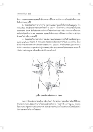 àÇªÈÒÊµÃ·¹ÂØ¤ 2553
          Ñ                                                                             481

¢ŒÒ§¢ÇÒ (right subphrenic space) ÍÕ¡´ŒÇÂ ¹Í¡¨Ò¡¹ÕÂ§ÊÒÁÒÃ¶àËç¹¡ÒÃºÒ´à¨çºµ‹ÍµÑº¡ÅÕº¢ÇÒáÅÐ
                                                  é Ñ
äµ¢ŒÒ§¢ÇÒºÒ§Ê‹Ç¹ä´Œ
         3. ºÃÔàÇ³ª‹Í§·ŒÍ§Ê‹Ç¹º¹´ŒÒ¹«ŒÒÂ â´ÂÇÒ§ probe µÒÁá¹ÇµÑ§·ÕºÃÔàÇ³àÊŒ¹ posterior ËÃ×Í
                                                                 é è
mid axillary ´ŒÒ¹«ŒÒÂÃÐËÇ‹Ò§¡ÃÐ´Ù¡«Õèâ¤Ã§·Õè 10 áÅÐ 11 à¾×èÍµÃÇ¨ËÒàÅ×Í´ËÃ×ÍÊÒÃ¹éíÒ·ÕèºÃÔàÇ³
splenorenal pouch «Öè§¤×Íª‹Í§ÃÐËÇ‹Ò§ÁŒÒÁáÅÐäµ¢ŒÒ§«ŒÒÂ¹Ñè¹àÍ§ ÃÇÁ¶Ö§àÅ×Í´ËÃ×ÍÊÒÃ¹éíÒºÃÔàÇ³
ª‹Í§ãµŒ¡ÐºÑ§ÅÁ¢ŒÒ§«ŒÒÂ (left subphrenic space) ÍÕ¡´ŒÇÂ ¹Í¡¨Ò¡¹ÕÂ§ÊÒÁÒÃ¶àËç¹¡ÒÃºÒ´à¨çºµ‹Í
                                                               é Ñ
ÁŒÒÁáÅÐäµ¢ŒÒ§«ŒÒÂºÒ§Ê‹Ç¹ä´Œ
         4. ºÃÔàÇ³ª‹Í§·ŒÍ§Ê‹Ç¹Å‹Ò§ â´ÂÇÒ§ probe µÒÁá¹Ç¹Í¹áÅÐá¹ÇµÑ§·ÕºÃÔàÇ³àË¹×Íµ‹Í¡ÃÐ´Ù¡
                                                                     é è
pubic symphysis »ÃÐÁÒ³ 4 à«¹µÔàÁµÃ à¾×ÍµÃÇ¨ËÒàÅ×Í´ËÃ×ÍÊÒÃ¹éÒã¹ª‹Í§ÍØ§àªÔ§¡ÃÒ¹ «Ö§ÍÂÙ‹
                                             è                     í       Œ            è
ÃÐËÇ‹Ò§¡ÃÐà¾ÒÐ»˜ÊÊÒÇÐ·Ò§´ŒÒ¹Ë¹ŒÒáÅÐÅíÒäÊŒµÃ§ (rectum) ·Ò§´ŒÒ¹ËÅÑ§ã¹¼ÙŒ»†ÇÂà¾ÈªÒÂ
·ÕàÃÕÂ¡Ç‹Ò Pouch of Douglas Ê‹Ç¹ã¹¼Ù»ÇÂà¾ÈË­Ô§¡ç¤Í rectouterine ËÃ×Í retrovesical recess «Ö§
  è                                  Œ †              ×                                    è
à»š¹ª‹Í§ÃÐËÇ‹Ò§Á´ÅÙ¡·Ò§´ŒÒ¹Ë¹ŒÒáÅÐÅíÒäÊŒµÃ§·Ò§´ŒÒ¹ËÅÑ§




                           ÃÙ»·Õè 1 áÊ´§µíÒáË¹‹§¡ÒÃµÃÇ¨ .AST

        ¹Í¡¨Ò¡µíÒáË¹‹§ÁÒµÃ°Ò¹´Ñ§¡Å‹ÒÇ¢ŒÒ§µŒ¹áÅŒÇ ÂÑ§ÍÒ¨à¾ÔÁ¡ÒÃµÃÇ¨à»š¹·Ò§àÅ×Í¡ä´ŒÍ¡ÊÍ§
                                                            è                         Õ
µíÒáË¹‹§¤×ÍµíÒáË¹‹§ª‹Í§Í¡Ê‹Ç¹Å‹Ò§·Ñ§¢ÇÒáÅÐ«ŒÒÂ (µíÒáË¹‹§ * ã¹ÃÙ»·Õè 1) â´ÂÇÒ§ probe µÒÁá¹Ç
                                   é
µÑ§ã¹µíÒáË¹‹§·ÕÊ§¡Ç‹ÒµíÒáË¹‹§ÁÒµÃ°Ò¹·Õè 2 áÅÐ 3 µÒÁÅíÒ´Ñºâ´Â·Ñ§ÊÍ§µíÒáË¹‹§¹ÕÁ»ÃÐâÂª¹à¾×Í
  é            èÙ                                              é              é Õ        è
ãªŒµÃÇ¨ËÒÊÒÃ¹éÒËÃ×ÍàÅ×Í´ã¹ª‹Í§Í¡
               í
 