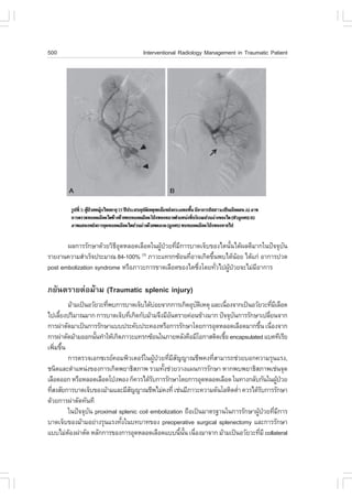 500                                  Interventional Radiology Management in Traumatic Patient




       ¼Å¡ÒÃÃÑ¡ÉÒ´ŒÇÂÇÔ¸Í´ËÅÍ´àÅ×Í´ã¹¼Ù»ÇÂ·ÕÁ¡ÒÃºÒ´à¨çº¢Í§äµ¹Ñ¹ä´Œ¼Å´ÕÁÒ¡ã¹»˜¨¨Øº¹
                         ÕØ             Œ † è Õ                  é               Ñ
ÃÒÂ§Ò¹¤ÇÒÁÊíÒàÃç¨»ÃÐÁÒ³ 84-100% ÀÒÇÐá·Ã¡«ŒÍ¹·ÕÍÒ¨à¡Ô´¢Ö¹¾ºä´Œ¹ÍÂ ä´Œá¡‹ ÍÒ¡ÒÃ»Ç´
                                  (3)
                                                  è       é         Œ
post embolization syndrome ËÃ×ÍÀÒÇÐ¡ÒÃ¢Ò´àÅ×Í´¢Í§äµ«Ö§â´Â·ÑÇä»¼Ù»ÇÂ¨ÐäÁ‹ÁÍÒ¡ÒÃ
                                                     è      è   Œ †      Õ

ÀÂÑ¹µÃÒÂµ‹ÍÁŒÒÁ (Traumatic splenic injury)
        ÁŒÒÁà»š¹ÍÇÑÂÇÐ·Õ¾º¡ÒÃºÒ´à¨çºä´ŒºÍÂ¨Ò¡¡ÒÃà¡Ô´ÍØºµàËµØ áÅÐà¹×Í§¨Ò¡à»š¹ÍÇÑÂÇÐ·ÕÁàÅ×Í´
                        è                   ‹               Ñ Ô      è                 è Õ
ä»àÅÕÂ§»ÃÔÁÒ³ÁÒ¡ ¡ÒÃºÒ´à¨çº·Õà¡Ô´¡ÑºÁŒÒÁ¨Ö§ÁÕÍ¹µÃÒÂ¤‹Í¹¢ŒÒ§ÁÒ¡ »˜¨¨Øº¹¡ÒÃÃÑ¡ÉÒà»ÅÕÂ¹¨Ò¡
      é                        è                 Ñ                     Ñ             è
¡ÒÃ¼‹ÒµÑ´ÁÒà»š¹¡ÒÃÃÑ¡ÉÒáºº»ÃÐ¤Ñº»ÃÐ¤Í§ËÃ×Í¡ÒÃÃÑ¡ÉÒâ´Â¡ÒÃÍØ´ËÅÍ´àÅ×Í´ÁÒ¡¢Ö¹ à¹×Í§¨Ò¡
                                                                                  é è
¡ÒÃ¼‹ÒµÑ´ÁŒÒÁÍÍ¡¹Ñ¹·íÒãËŒà¡Ô´ÀÒÇÐá·Ã¡«ŒÍ¹ã¹ÀÒÂËÅÑ§¤×ÍÁÕâÍ¡ÒÊµÔ´àª×Í encapsulated áº¤·ÕàÃÕÂ
                   é                                               é
à¾ÔÁ¢Ö¹
    è é
        ¡ÒÃµÃÇ¨àÍ¡«àÃÂ¤ÍÁ¾ÔÇàµÍÃã¹¼Ù»ÇÂ·ÕÁÊ­­Ò³ªÕ¾¤§·ÕÊÒÁÒÃ¶ª‹ÇÂºÍ¡¤ÇÒÁÃØ¹áÃ§,
                                           Œ † è Õ Ñ            è
ª¹Ô´áÅÐµíÒáË¹‹§¢Í§¡ÒÃà¡Ô´¾ÂÒ¸ÔÊÀÒ¾ ÃÇÁ·Ñ§ª‹ÇÂÇÒ§á¼¹¡ÒÃÃÑ¡ÉÒ ËÒ¡¾º¾ÂÒ¸ÔÊÀÒ¾àª‹¹¨Ø´
                                               é
àÅ×Í´ÍÍ¡ ËÃ×ÍËÅÍ´àÅ×Í´â»†§¾Í§ ¡ç¤ÇÃä´ŒÃº¡ÒÃÃÑ¡ÉÒâ´Â¡ÒÃÍØ´ËÅÍ´àÅ×Í´ ã¹·Ò§¡ÅÑº¡Ñ¹ã¹¼Ù»ÇÂ
                                         Ñ                                                 Œ †
·ÕÊ§ÊÑÂ¡ÒÃºÒ´à¨çº¢Í§ÁŒÒÁáÅÐÁÕÊ­­Ò³ªÕ¾äÁ‹¤§·Õè àª‹¹ÁÕÀÒÇÐ¤ÇÒÁ´Ñ¹âÅËÔµµèÒ ¤ÇÃä´ŒÃº¡ÒÃÃÑ¡ÉÒ
  è                              Ñ                                       í         Ñ
´ŒÇÂ¡ÒÃ¼‹ÒµÑ´·Ñ¹·Õ
        ã¹»˜¨¨Øº¹ proximal splenic coil embolization ¶×Íà»š¹ÁÒµÃ°Ò¹ã¹¡ÒÃÃÑ¡ÉÒ¼Ù»ÇÂ·ÕÁ¡ÒÃ
                Ñ                                                              Œ † è Õ
ºÒ´à¨çº¢Í§ÁŒÒÁÍÂ‹Ò§ÃØ¹áÃ§·Ñ§ã¹º·ºÒ·¢Í§ preoperative surgical splenectomy áÅÐ¡ÒÃÃÑ¡ÉÒ
                             é
áººäÁ‹µÍ§¼‹ÒµÑ´ ËÅÑ¡¡ÒÃ¢Í§¡ÒÃÍØ´ËÅÍ´àÅ×Í´áºº¹Õ¹¹ à¹×Í§ÁÒ¨Ò¡ ÁŒÒÁà»š¹ÍÇÑÂÇÐ·ÕÁÕ collateral
         Œ                                           é Ñé è                     è
 