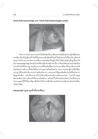 598                                                                    ¤ÇÒÁ¼Ô´»¡µÔ¢Í§ÊÒÂàÊÕÂ§

Vocal fold hemorrhage áÅÐ Vocal fold (hemorrhagic) polyp




         à¡Ô´¨Ò¡¡ÒÃµÐâ¡¹áÃ§æáÅŒÇ·íÒãËŒàÊŒ¹àÅ×Í´·ÕÊÒÂàÊÕÂ§áµ¡à¡Ô´ÁÕàÅ×Í´ÍÍ¡ÍÂÙã¹ªÑ¹¼ÔÇ¢Í§
                                                    è                              ‹ é
ÊÒÂàÊÕÂ§ ËÃ×Íà¡Ô´ã¹¼Ù»ÇÂ·Õ¡ÒÅÑ§ä´ŒÃºÂÒÅÐÅÒÂÅÔÁàÅ×Í´«Ö§â´Â·ÑÇä»ÁÑ¡¨ÐËÒÂä»ä´ŒÀÒÂã¹ 2 ÊÑ»´ÒË
                     Œ † è í       Ñ          è         è      è
áµ‹ÍÂ‹Ò§äÃ¡çµÒÁÍÒ¨¨Ðà¡Ô´¡ÒÃ§Í¡¢Öé¹ÁÒ¢Í§ÊŒ¹àÅ×Í´·ÕèÍÂÙ‹¢ŒÒ§ãµŒ·íÒãËŒà¡Ô´à»š¹µÔè§à¹×éÍ¹Ù¹¢Öé¹ÁÒä´Œ
àÃÕÂ¡ hemorrhagic polyp â´ÂÁÑ¡¨Ðà¡Ô´·ÕÊÒÂàÊÕÂ§¢ŒÒ§à´ÕÂÇà·‹Ò¹Ñ¹ ¡ÒÃÃÑ¡ÉÒãËŒËÂØ´ÂÒÅÐÅÒÂÅÔÁàÅ×Í´
                                      è                      é                            è
ã¹ÃÒÂ·Õ¡ÒÅÑ§ä´ŒÃºÂÒÍÂÙ‹ áÅÐà¹×Í§¨Ò¡¡Ã´·ÕäËÅÂŒÍ¹¢Ö¹ÁÒ¨Ò¡¡ÃÐà¾ÒÐ¢Ö¹ÁÒ·Õ¡Å‹Í§àÊÕÂ§¨Ð·íÒãËŒ
        è í        Ñ           è          è           é                é     è
àÊŒ¹àÅ×Í´¢ÂÒÂµÑÇÁÒ¡¢Öé¹´Ñ§¹Ñé¹¨Ö§¤ÇÃ¤Çº¤ØÁ¡Ã´äËÅÂŒÍ¹´ŒÇÂ áÅÐ¤ÇÃá¹Ð¹íÒ¼ÙŒ»†ÇÂãËŒãªŒàÊÕÂ§
ÍÂ‹Ò§¶Ù¡ÇÔ¸Õâ´ÂËÅÕ¡àÅÕÂ§¡ÒÃµÐâ¡¹àÊÕÂ§´Ñ§ÁÒ¡æ áÅÐá¹Ð¹íÒÇÔ¸Õ´ÙáÅàÊŒ¹àÊÕÂ§â´ÂãËŒ´×èÁ¹éíÒÁÒ¡æ
äÁ‹¾Ù´à¤Œ¹àÊÕÂ§ ËÅÕ¡àÅÕèÂ§ÍÒËÒÃ·Õè·íÒãËŒÊÒÂàÊÕÂ§áËŒ§àª‹¹¡Òá¿áÅÐ¢Í§·Í´ ã¹ÃÒÂ·Õè polyp
ÁÕ¢¹Ò´àÅç¡ÍÒ¨¨ÐËÒÂä»àÍ§ä´Œã¹àÇÅÒà»š¹à´×Í¹æ áµ‹â´Â·ÑÇä»ÁÑ¡¨ÐµŒÍ§¼‹ÒµÑ´ÍÍ¡ â´Â·Õ¾ÂÒÂÒÁ
                                                          è                            è
à¡çº mucosa ·Õ´äÇŒãËŒÁÒ¡·ÕÊ´ à¾×Í·Õ¨Ð·íÒãËŒ¡ÒÃà¤Å×Í¹äËÇ¢Í§¼ÔÇ¢Í§ÊÒÂàÊÕÂ§¨Ð¡ÅÑºÁÒã¡ÅŒà¤ÕÂ§
               è Õ        èØ è è                  è
»¡µÔÁÒ¡·ÕÊ´ èØ

Intracordal cyst (¶Ø§¹éíÒ·ÕèÊÒÂàÊÕÂ§)
 